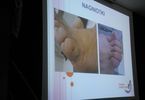 Wykład UTW: Leczenie schorzeń w obrębie skóry stóp oraz paznokci